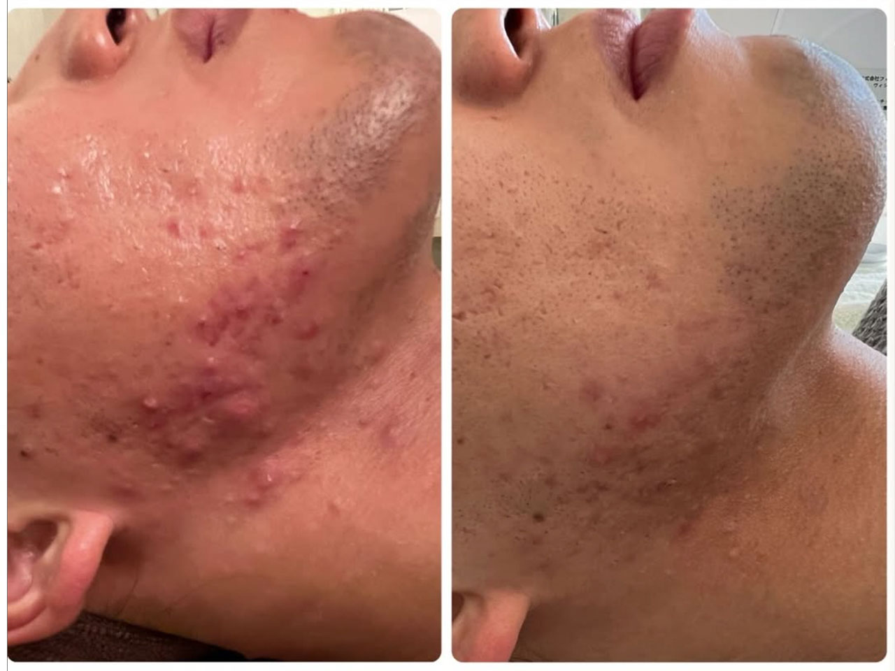 メンズ症例写真2